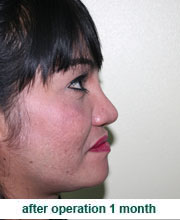 plastic_surgery_augmentation_rhinoplasty